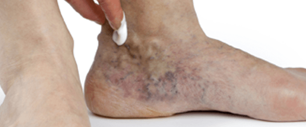 spider veins on foot