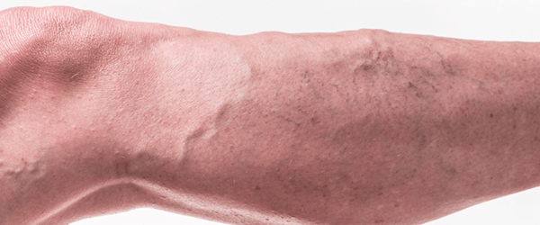 varicose veins